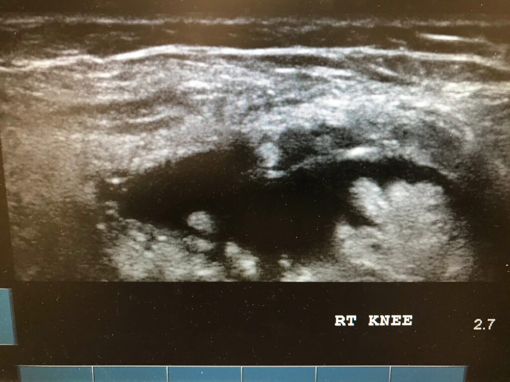 knee ultrasound
